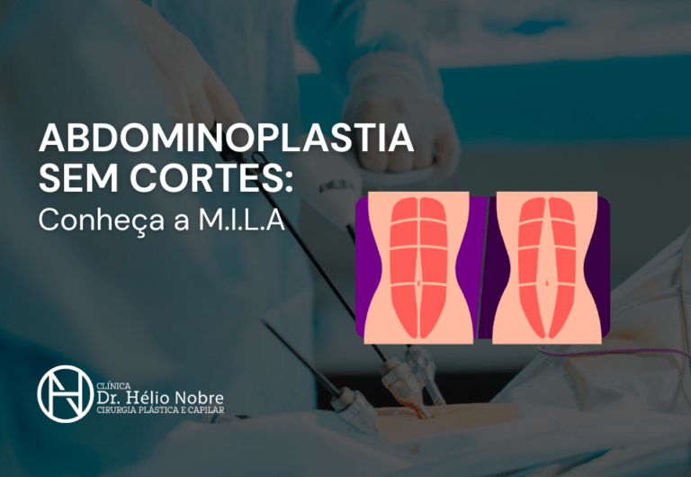 Abdominoplastia Sem Cortes Conheça a M I L A Dr Hélio Nobre