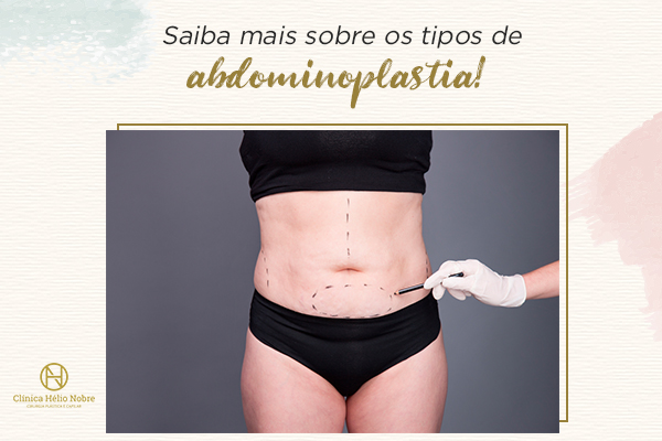 Quais Os Tipos De Abdominoplastia Clínica Dr Hélio Nobre Cirurgia Plástica E Transplante